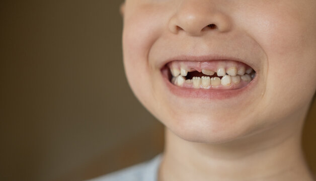 A cheerful child proudly showing a missing upper milk tooth. Concept of childhood growth, dental development, and family moments. Perfect for pediatric dentistry, tooth loss. 