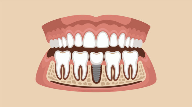 Medical illustration showing a single tooth dental implant anchored into the lower jawbone between natural teeth.