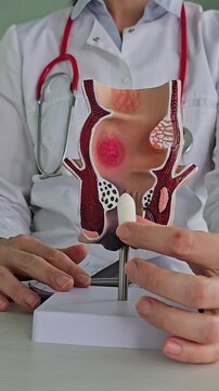 Treatment of rectal diseases, hemorrhoids, and constipation. A proctologist inserts a rectal suppository into an artificial model of the human rectum.