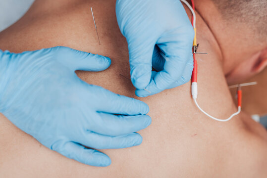 Therapist inserting additional acupuncture needles into upper back muscles during electroacupuncture treatment for pain management and recovery