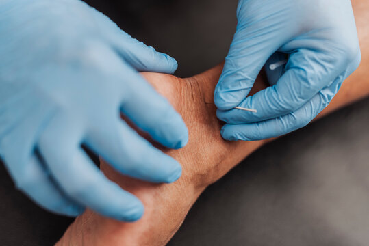 Close up of male patient receiving acupuncture on ankle area to support pain relief, recovery, circulation and joint function