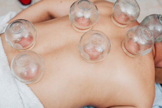 Glass cupping therapy or ventosa on back muscles of a middle aged man for pain relief, circulation improvement and recovery