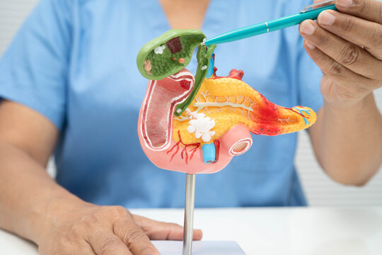 Pancreatitis, pancreatic cancer, Asian doctor with pancreas, gallbladder and bile duct human anatomy model at hospital.