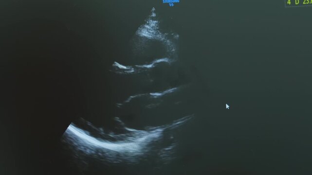 Sharp ultrasound display reveals structure of heart in motion. Monitor displays clear image of beating heart accompanied by regular pulse sound