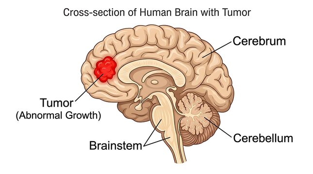Cross-section of human brain with tumor, medical illustration