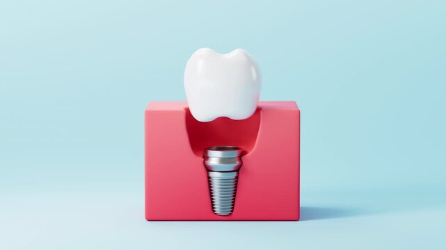 Dental implant surgery process. A concept of implantation teeth and dental surgery. 3d rendering.