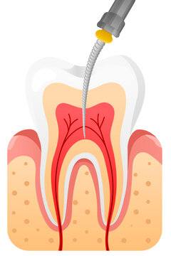 Tooth root canal dental drill endodontic dental care oral health dentistry dental treatment tooth anatomy medical illustration calm educational vector shows tooth root canal dental drill procedure