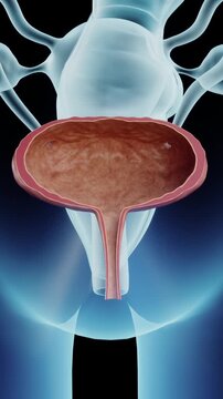 3D rendering of cystitis &ndash; infection of the bladder mucosa. UTI spreads through the urinary tract, causing burning, urgency, and lower abdominal pain. Urinary system disease.