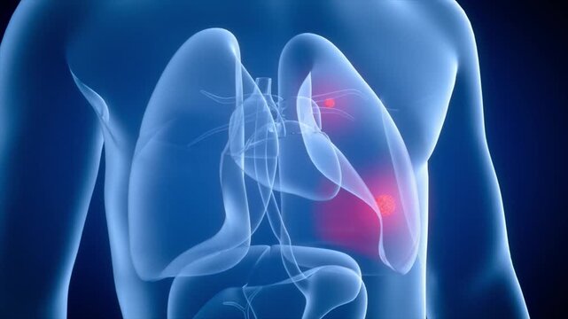 Lung tumors grow and spread as cancer worsens the condition. 3D animation of malignant progression through pulmonary tissue and metastasis.