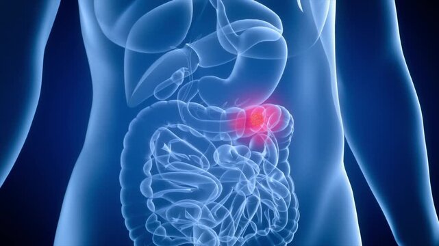 Intestinal tumors grow and spread, causing cancer to worsen the condition. 3D animation of malignant progression in the gastrointestinal tract.