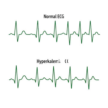 Comparison of normal and hypertensive ecg tracings