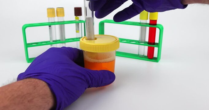 Hands in blue gloves inserting a vacuum test tube into a container with a urine sample for laboratory testing on white background