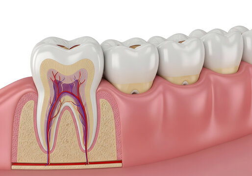 Anatomical cross section of a human tooth showing deep decay pulpitis infection and inflammation of blood vessels