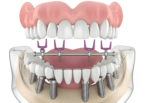 Full arch dental implant restoration with a metal bar and attachment system for a secure and stable denture