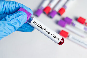 Obraz premium Hantavirus Test Sample in Medical Laboratory