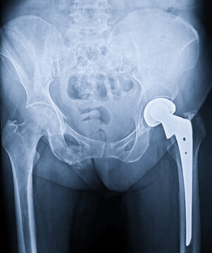 Medical X-ray of a pelvis showing a total hip joint replacement surgery with metal prosthetic implants.