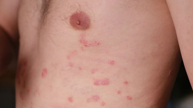 Male with psoriasis lightly scratches his chest, revealing the progression of skin condition across three frames in a softly lit indoor environment