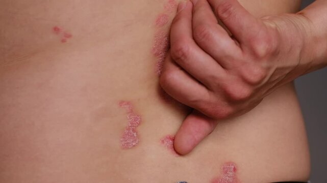 Close-up view of a person pressing on psoriasis lesions on the lower back, highlighting skin texture and irritation in a neutral background