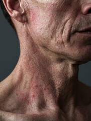 Naklejka premium Weathered male neck and jawline with red dry skin irritation and rough texture under natural side light on dark background