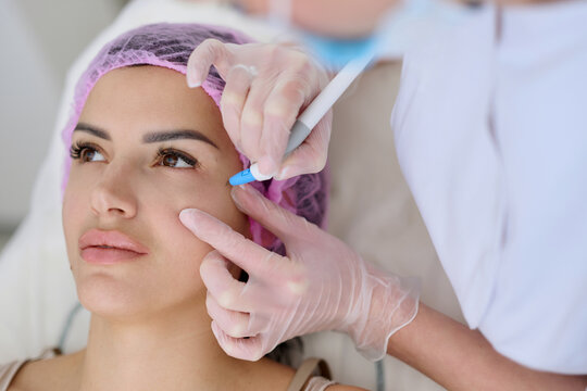 Cosmetic facial marking before aesthetic procedure