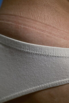 Uncomfortable Lines and Traces On Skin From Underwear Close-up