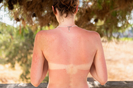 Sunburned skin on a woman back with visible bikini tan lines