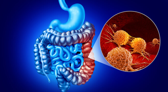 Colon Cancer Screening concept featuring colorectal and large intestine colonoscopy examination early cancer detection precancerous polyp identification digestive health cancer prevention medical diag