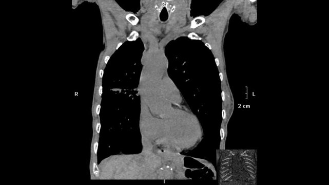 chest CT image demonstrating detailed lung parenchyma, airways, and mediastinal structures. Derived from real CT imaging data for clinical assessment, not AI-generated