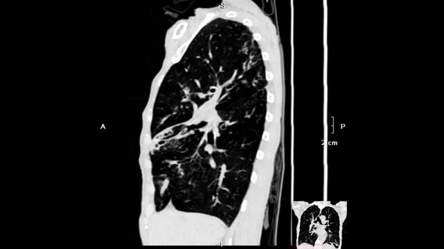 chest CT image demonstrating detailed lung parenchyma, airways, and mediastinal structures. Derived from real CT imaging data for clinical assessment, not AI-generated