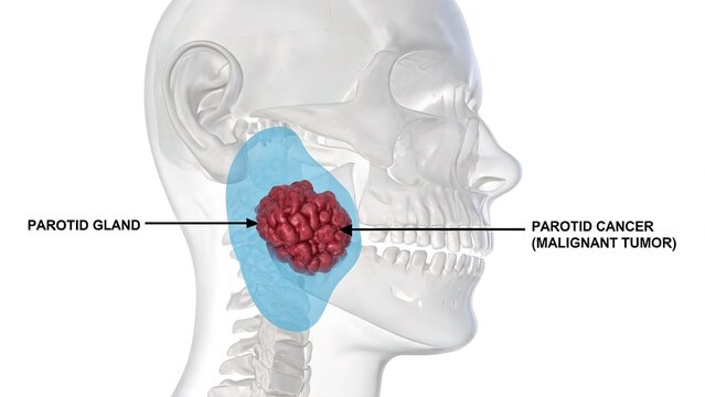 Labeled 3D Medical Diagram of Parotid Gland Cancer, Malignant Tumor Inside Human Salivary Parotid Gland with Skull and Jaw Anatomy
