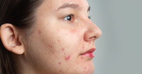 Pimple on cheek in profile. Pimple on skin for dermatology. Pimple on face in closeup. Pimple...