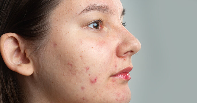 Pimple on cheek in profile. Pimple on skin for dermatology. Pimple on face in closeup. Pimple problem on female skin. Acne closeup on profile face. Acne skin problem on cheek. Acne oily skin.