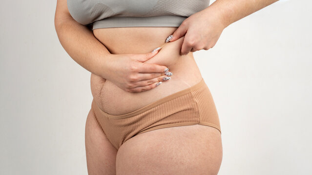Woman pinching abdominal fat with visible cellulite. Close up of belly fat and real skin texture. Natural female body with skin dimples and hips. Cellulite and subcutaneous fat on abdomen and thighs.