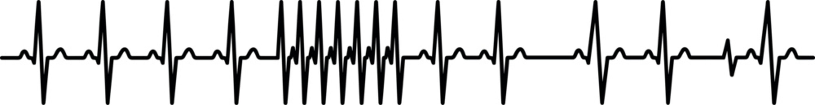 Electrocardiogram ECG heartbeat waveform with arrhythmia episode isolated on light background medical monitoring illustration