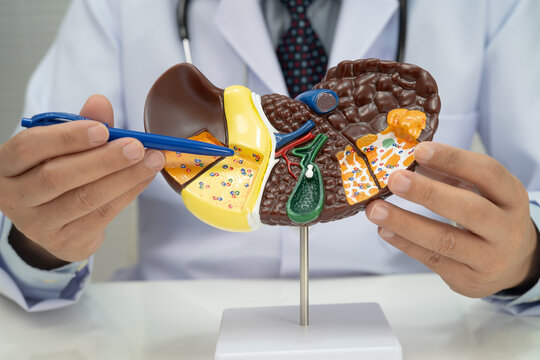Cirrhosis, Liver cancer, fatty liver, Asian doctor with liver human model.