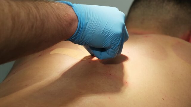 Dermatologist applies bandage onto wounds of cut moles on man back in hospital slow motion. Surgeon finishes wart removal procedure in clinic