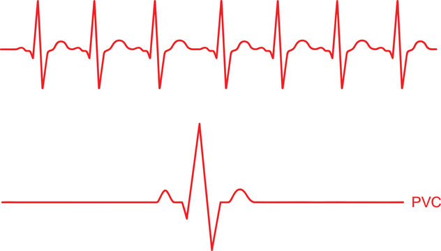 Heart rhythm medical electrocardiogram showing normal sinus beat and pvc complex