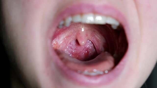 Close up of an open mouth showing inflamed tonsils and throat. Medical examination, oral health, sore throat. Palatine uvula. Removed tonsils. A phoniatrist checks the ligaments and speech apparatus