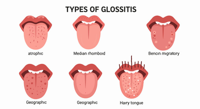 Different types of tongue conditions illustrated