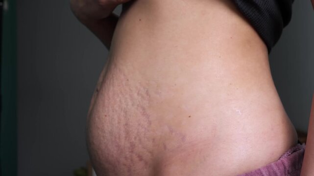 Woman pinching loose skin on her postpartum belly with stretch marks
