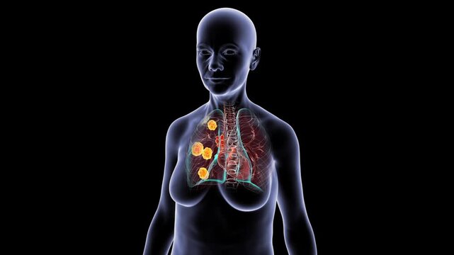 Pulmonary blastomycosis in female silhouette, 3D animation showing fungal inflammatory nodules within lungs, transparent thorax rotating on black background.