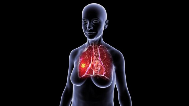 Lung cancer in female silhouette, 3D animation showing malignant tumour mass within lung tissue, transparent thorax rotating on black background.