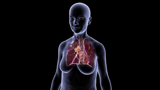 Primary tuberculosis Ranke complex in female silhouette, 3D animation showing calcified lung focus and healed hilar lymph nodes, transparent thorax rotating on black background.