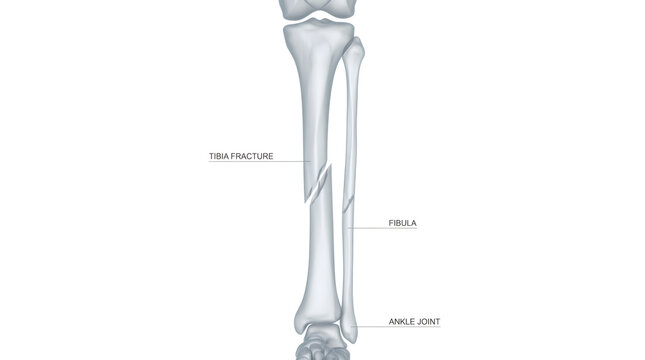 Medical illustration of human lower leg showing a tibia fracture and fibula