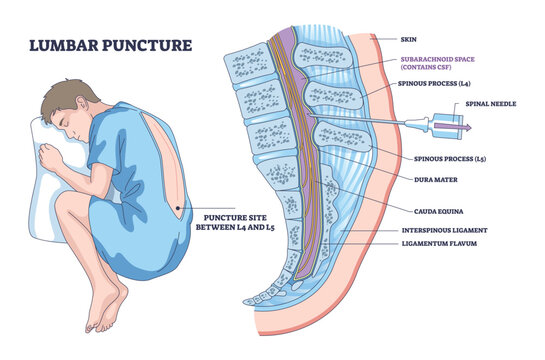 Lumbar puncture brief diagram shows curled patient and spinal needle entering L4 L5 for CSF access, highlighting vertebrae, key objects, patient, needle, vertebrae. Outline diagram