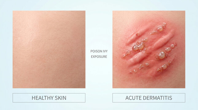 ​3D Clinical Illustration of Acute Dermatitis from Poison Ivy Exposure