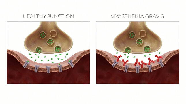 Myasthenia Gravis Neuromuscular Junction Autoimmune Disease