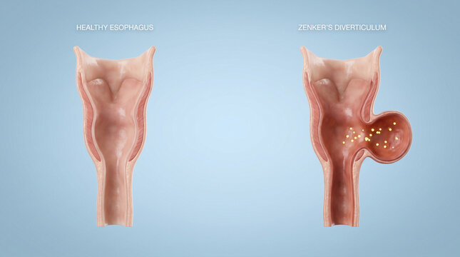 Zenkers Diverticulum Esophageal Pouch Medical Anatomy Diagram