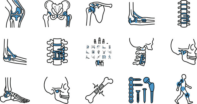 Orthopedic anatomy and implant illustration set showing joints bones and surgical fixation devices for medical and healthcare education artwork
