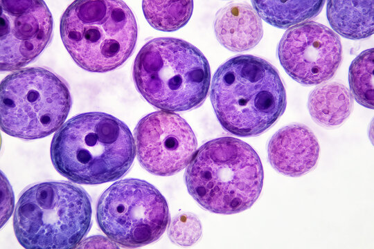 Microscopic view of multiple myeloma cancer cells with abnormal plasma cell structures